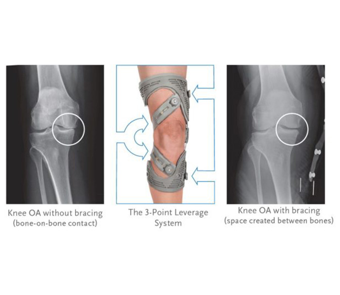 SecuTec OA Knee Brace – Shop Knee Rehab Braces